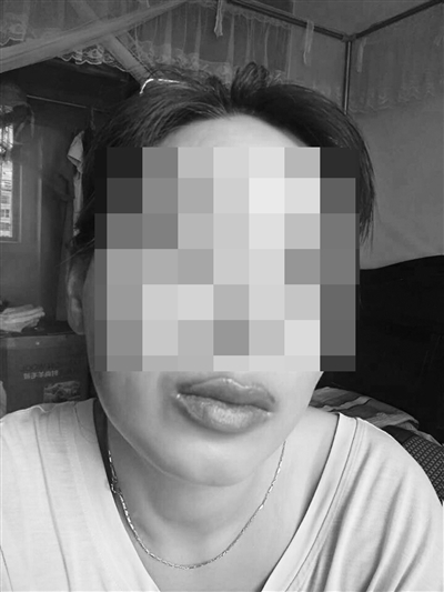 海口一女子文唇2个多月肿痛未消向文唇师讨说法
