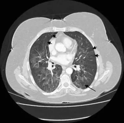 喘息、呼衰1年，问病史才发现是这个病！