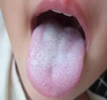 小儿舌苔白腻,小儿斑驳舌苔
