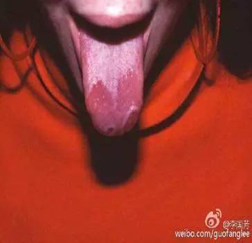 小儿舌苔白腻,小儿斑驳舌苔