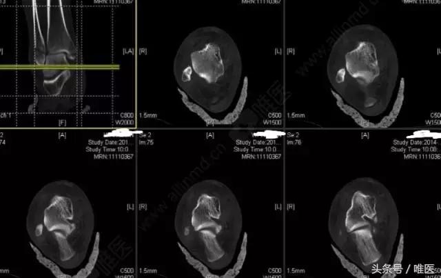 脚踝骨折手术内固定图片,踝关节骨折切开复位内固定术步骤