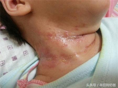宝宝淹脖子有汗疹用什么好,宝宝淹脖子可以涂湿疹膏吗