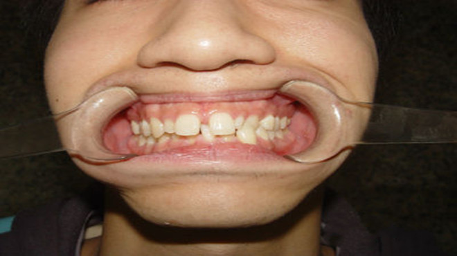 牙齿缝隙越来越大怎么解决,牙齿缝隙越变越大了怎么办