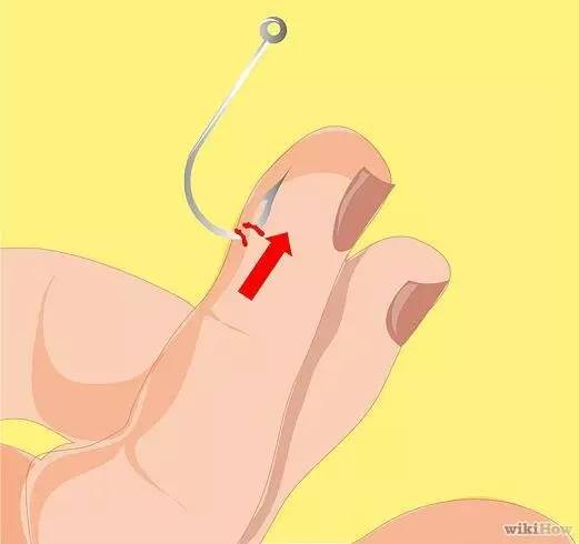 鱼钩钩到手指怎么办,鱼钩钩住手会得破伤风吗