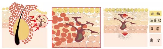痘印区分,怎样判断自己是痘印还是痘坑
