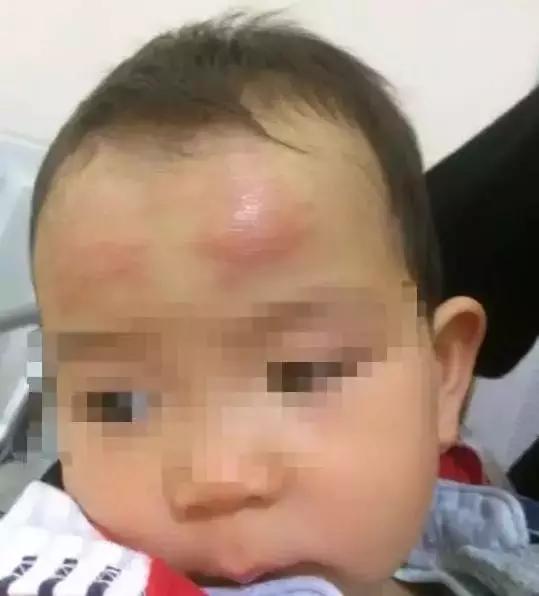 8个月宝宝发烧退热贴管用么,宝宝额头摔肿了用退烧贴可以吗