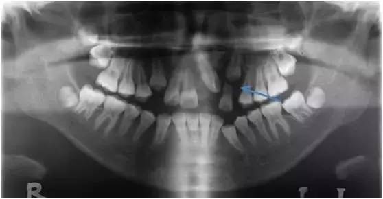 替牙期牙齿需要矫正吗,替牙期牙齿