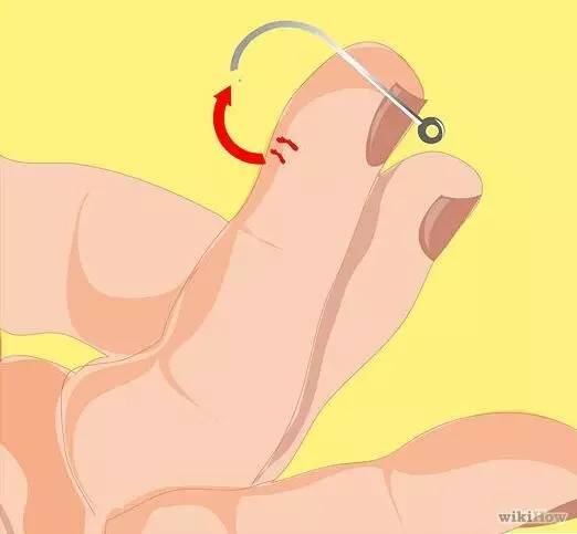 鱼钩钩到手指怎么办,鱼钩钩住手会得破伤风吗