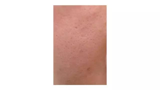 娣″寲鐥樺嵃鐥樺潙姣涘瓟绮楀ぇ鐢风敓,骞垮窞娣″寲鐥樺嵃鐥樺潙姣涘瓟绮楀ぇ