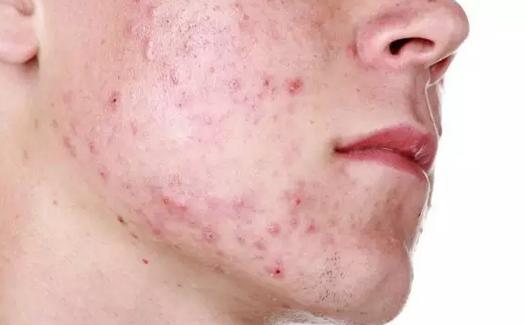 痘印区分,怎样判断自己是痘印还是痘坑