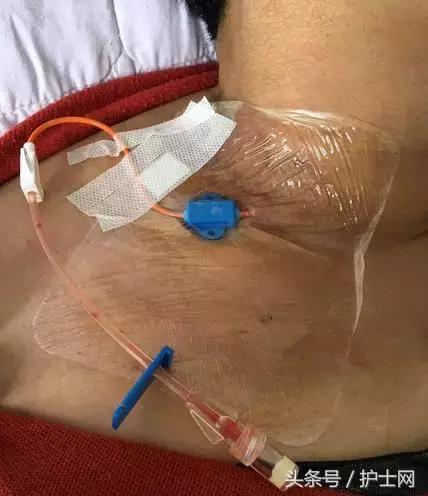 更换敷贴的操作视频,怎么换敷贴