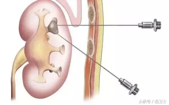 有关肾穿刺的问答清单，好多人都收藏了！