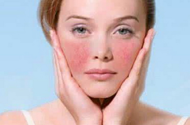 脸上一直好不了的*血丝红**需看完，你真的相信洋甘菊能彻底除掉它？