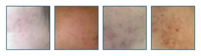 娣″寲鐥樺嵃鐥樺潙姣涘瓟绮楀ぇ鐢风敓,骞垮窞娣″寲鐥樺嵃鐥樺潙姣涘瓟绮楀ぇ