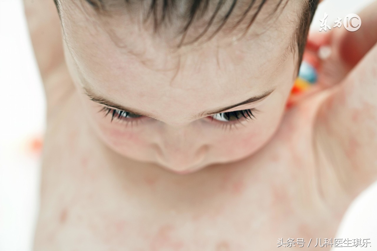 小孩痱子和湿疹的区别,湿疹和痱子应该怎样区别