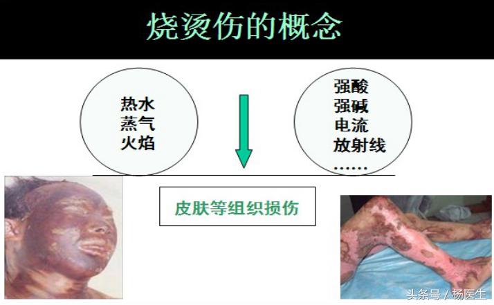 烫伤家庭急救五字诀,烧烫伤急救五部曲图片