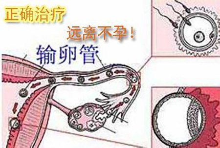 输卵管通水后更加易堵吗,输卵管堵塞通液后要关注什么