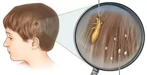 孩子头发有头皮屑原因,孩子头发痒有头皮屑怎么办