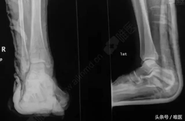 脚踝骨折手术内固定图片,踝关节骨折切开复位内固定术步骤