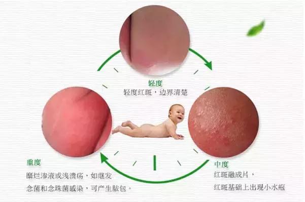 夏天孩子预防红屁屁,夏天宝宝红屁屁