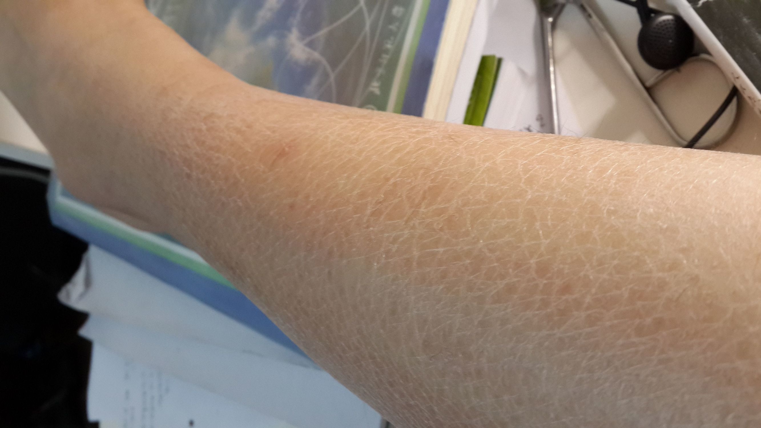 身上皮肤干燥起皮怎么办,冷天身上起皮干燥是什么皮肤