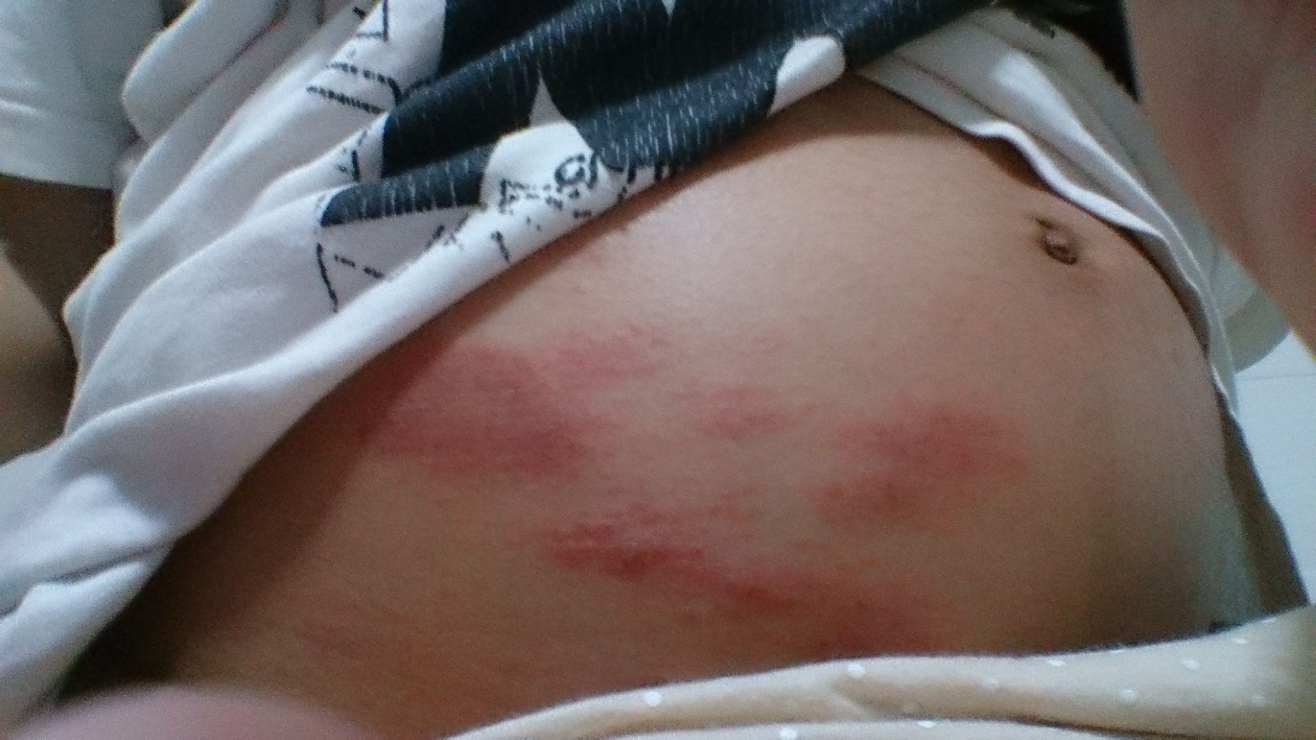 孕期肚子痒需要查什么吗,孕期肚子痒有什么办法