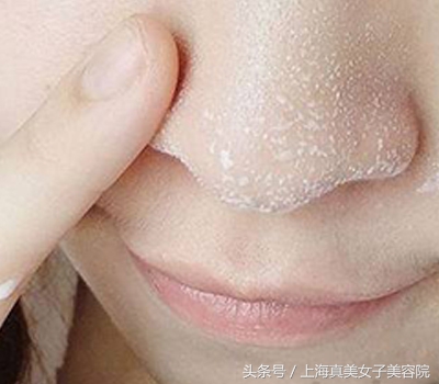 鼻子黑头怎么去除最有效知乎,小孩鼻子上黑头怎么去除最有效