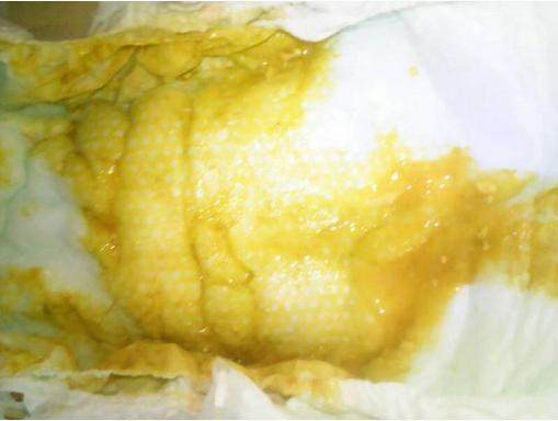 吃母乳宝宝拉稀怎么看有没有奶瓣,宝宝吃母乳就拉稀看什么科