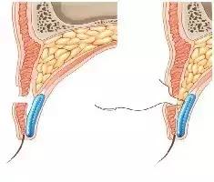 拯救三眼皮的方法,术后出现三眼皮算手术失败吗