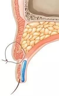 拯救三眼皮的方法,术后出现三眼皮算手术失败吗
