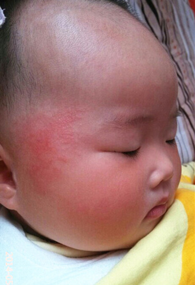 婴儿被蚊子叮咬起水泡需要处理吗,婴儿被蚊子叮咬后红肿硬起小水泡