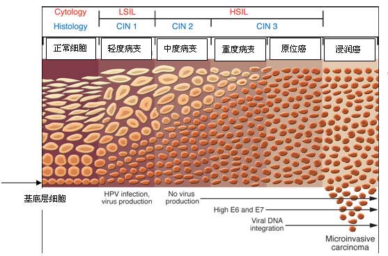 hpv35阳性宫颈癌的几率,hpv全阴性得宫颈癌的几率大么