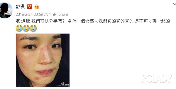 紫外线过敏舒淇,舒淇敏感肌怎么自救