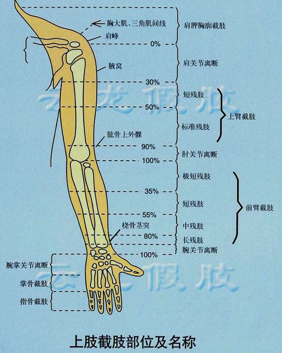 截肢后戴假肢老是疼怎么处理,截肢病人关注事项