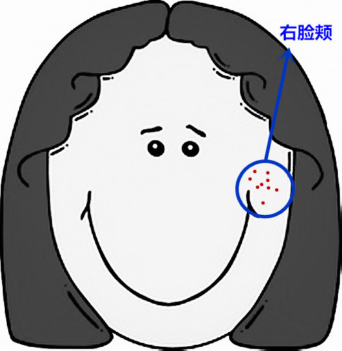 超全面面部痘痘分析图文，了解身体状况！