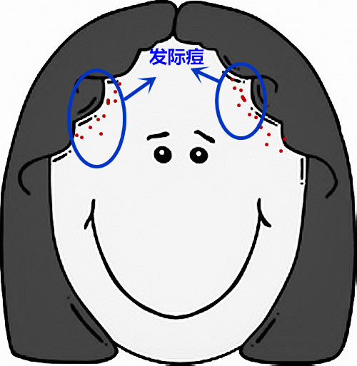 超全面面部痘痘分析图文，了解身体状况！