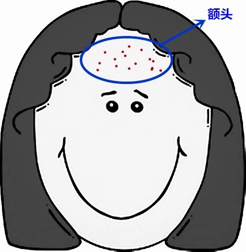 超全面面部痘痘分析图文，了解身体状况！