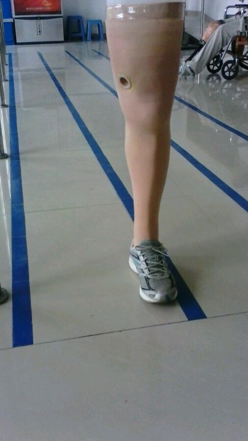 截肢后戴假肢老是疼怎么处理,截肢病人关注事项