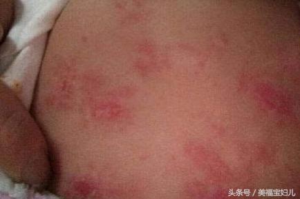 湿疹皮肤瘙痒不要慌用对方法,宝宝得了湿疹怎么处理好得快