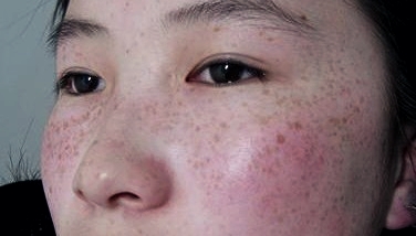 生孩子后脸色暗黄有斑怎么办,生孩子后长斑什么原因