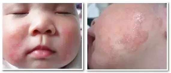 痱子不小心当湿疹治疗会怎么样,痱子小红点