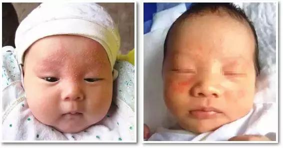 痱子不小心当湿疹治疗会怎么样,痱子小红点