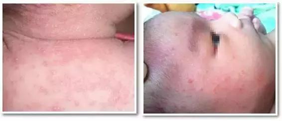 痱子不小心当湿疹治疗会怎么样,痱子小红点