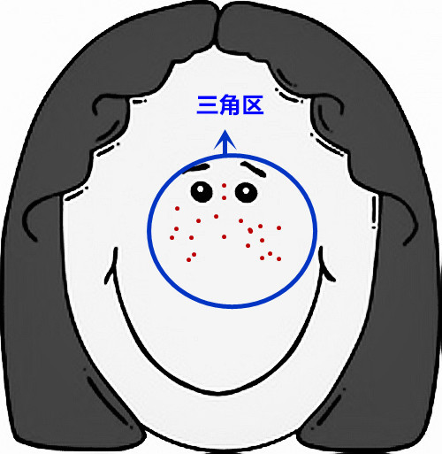 超全面面部痘痘分析图文，了解身体状况！