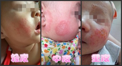湿疹怎么引起的小孩,湿疹是怎么样引起的用什么药膏
