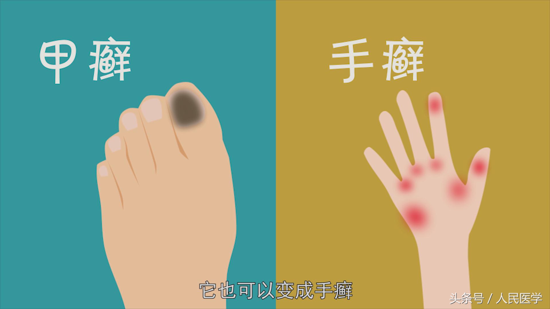 脚气被称作香港脚又叫什么,脚气与香港脚的区别