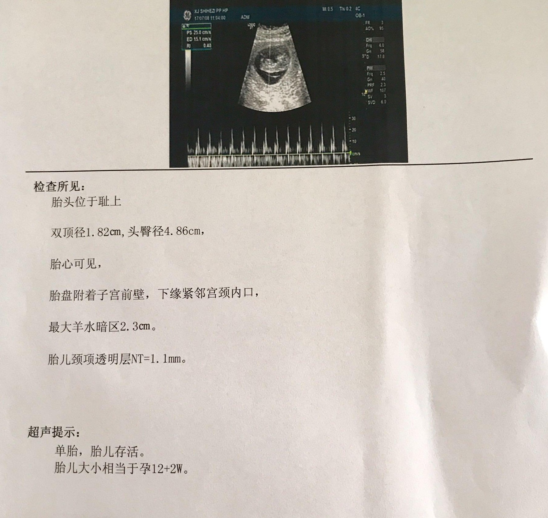 孕12周nt检查需要准备什么,12周nt胎心率169正常吗