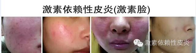 激素脸是什么病造成的,激素脸是什么症状