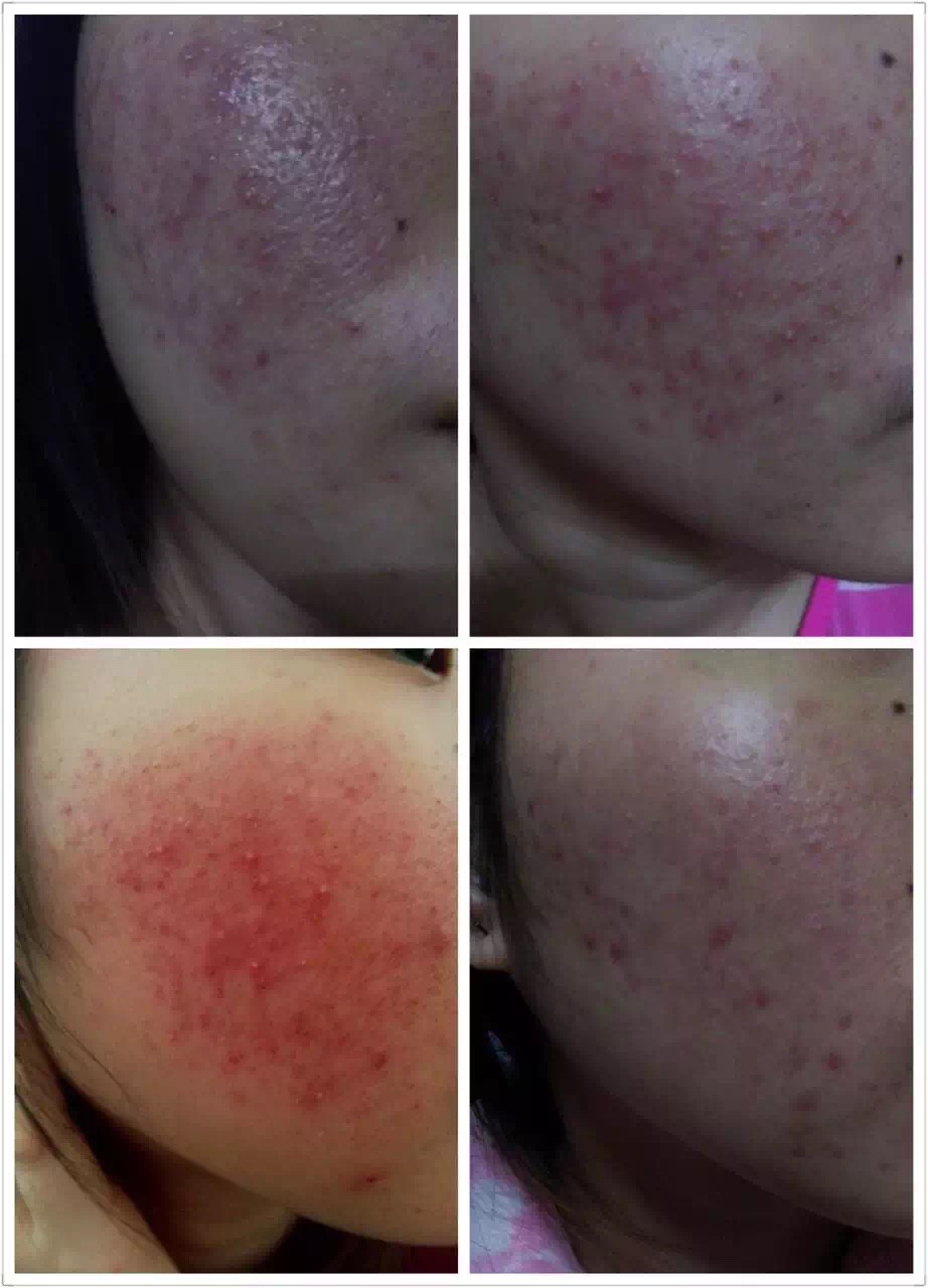 慎入！春季多发激素脸！你还要不要脸？