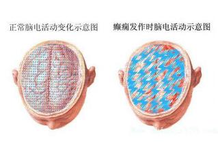 孩子真的得了癫痫家长该怎么办,家长如何识别癫痫病发作